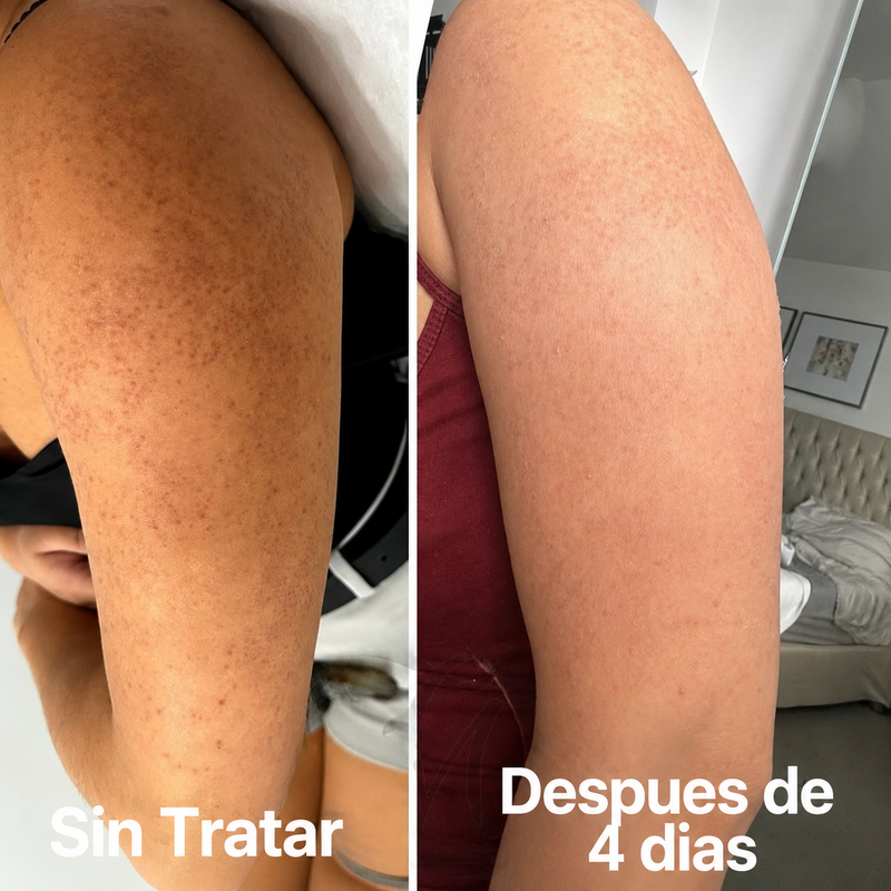 Antes y despues en brazos a los 4 dias